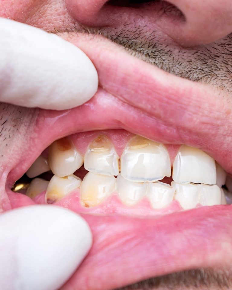 Lee más sobre el artículo El esmalte dental y el paso del tiempo: lo que sí puedes hacer para protegerlo