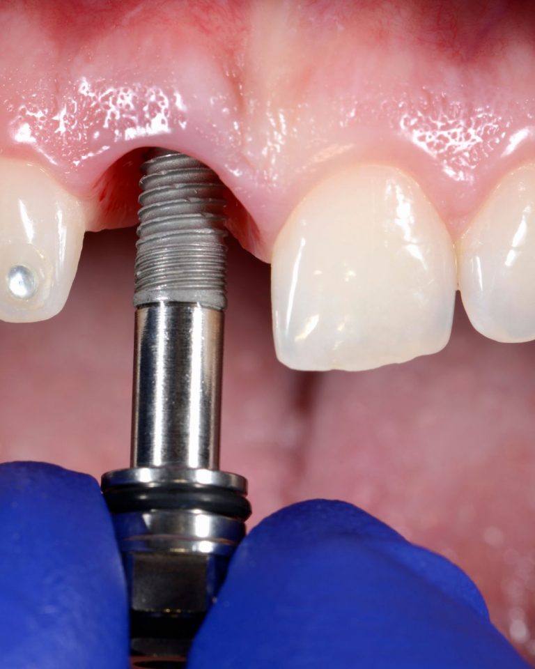 Lee más sobre el artículo Extracción dental e implante: ¿cuánto tiempo debes esperar (y por qué)?